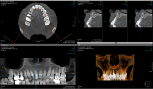 One-stage implantation in aesthetically significant area, the area of a tooth 1.1, Dr. Khabibbulo Negmatov