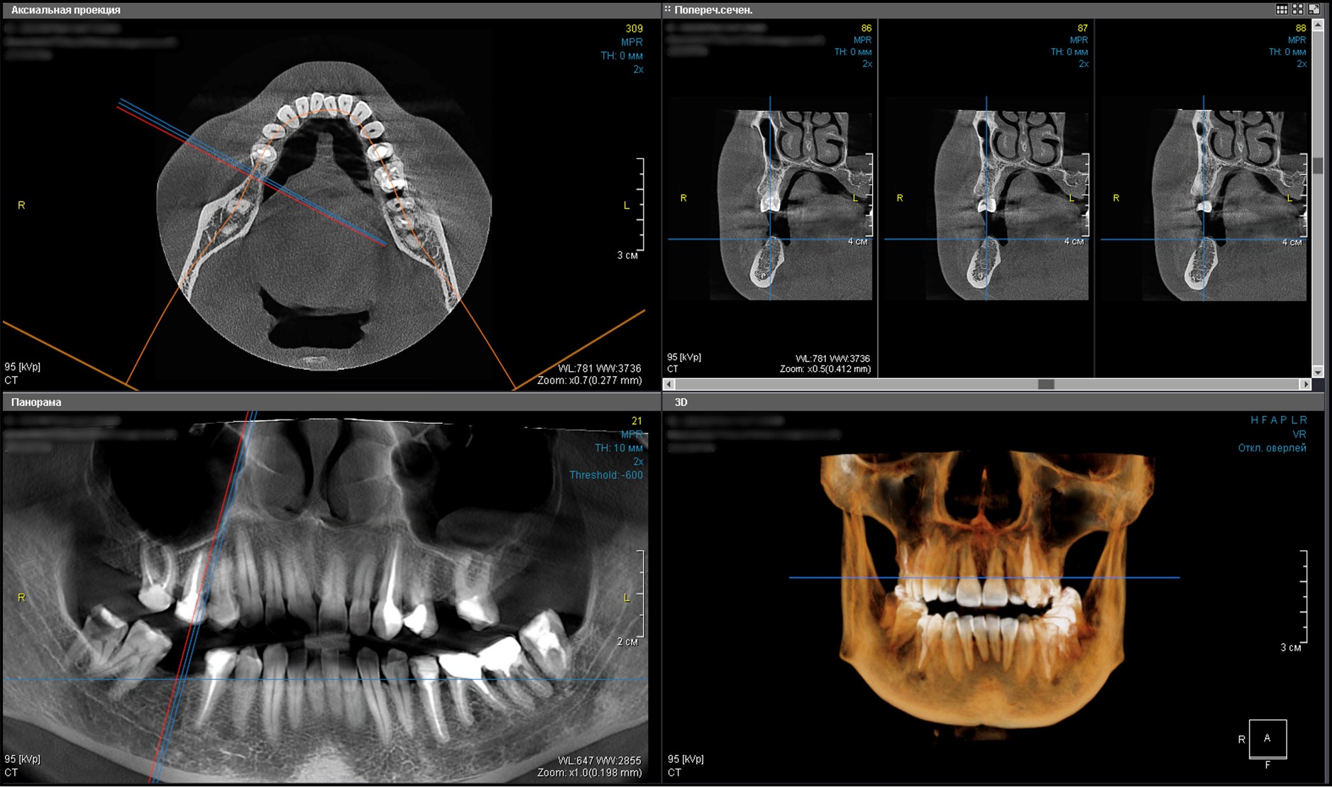 Standard implantation in the region of tooth 4.6, Dr. Khabibullo Negmatov