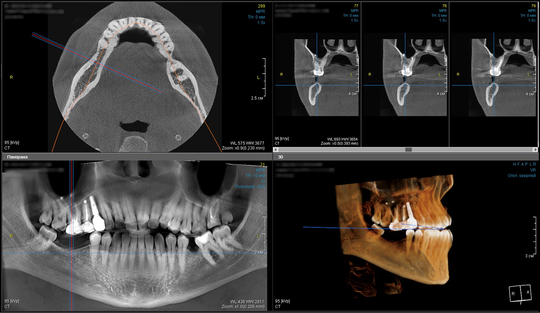 Standard implantation in teeth 4.6 and 4.7 (Dr. Khabibullo Negmatov)