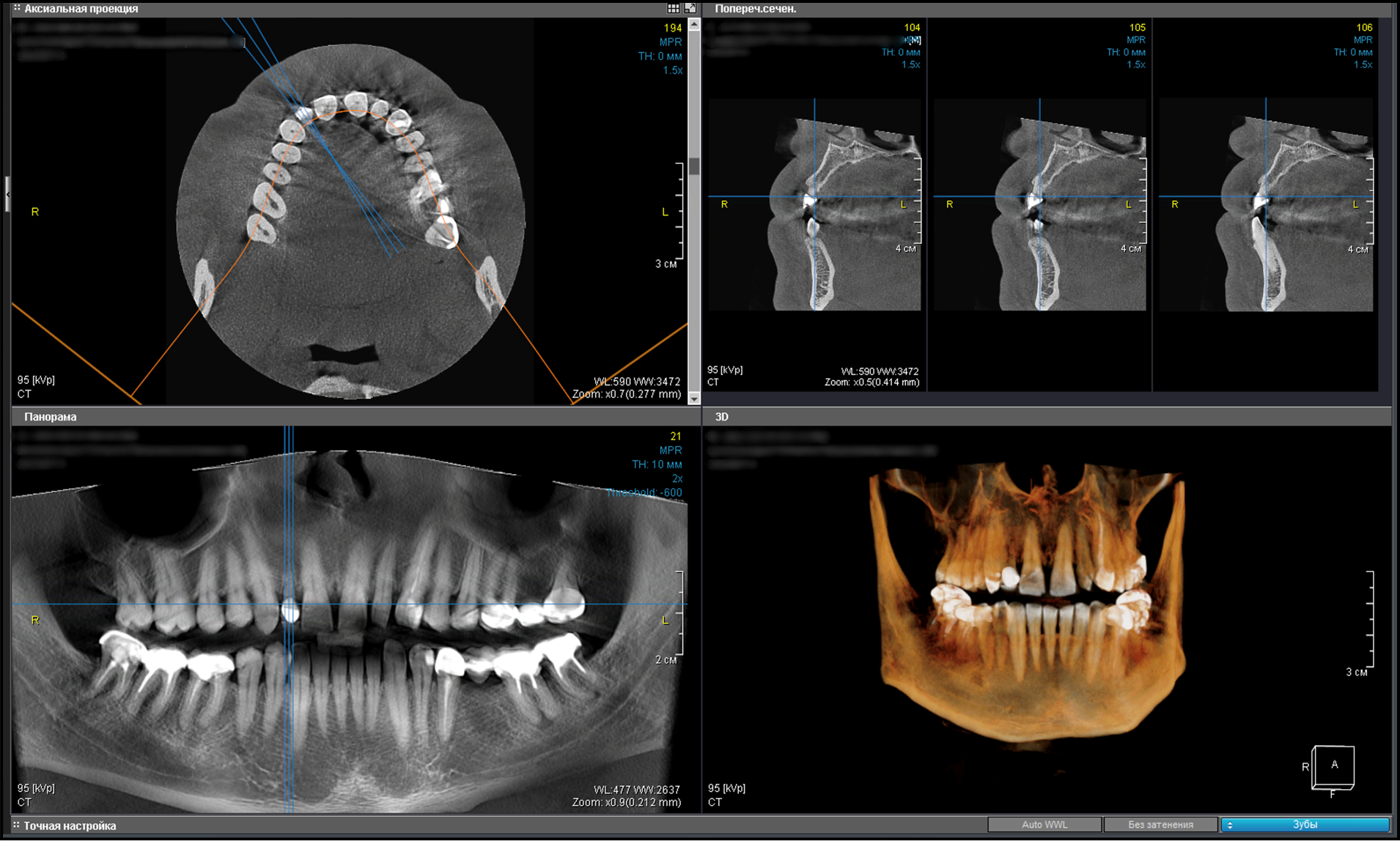 One-stage implantation in the aesthetic region of tooth 1.2 with immediate loading, Dr. Khabibullo Negmatov