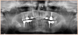 Immediate placement of SGS Dental implants in premolar and molar fresh extraction sockets in the mandible, by Dr. Irfan Qureshi (Karachi, Pakistan)