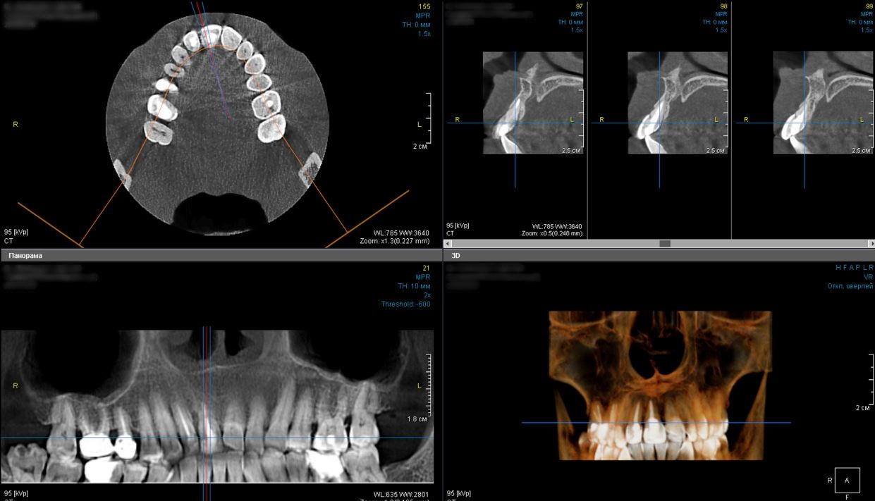 One-stage implantation in the aesthetic region of tooth 1.1, Dr. Khabibullo Negmatov