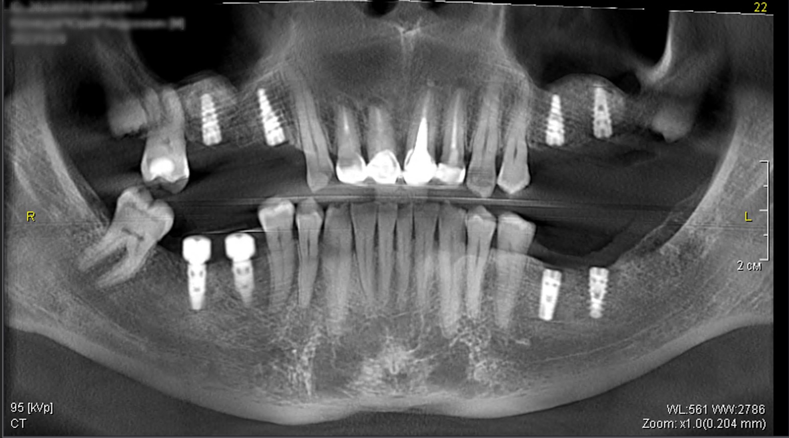 Rehabilitation of a patient with partially edentulous chewing teeth using SGS Dental implants, Dr. Khabibullo Negmatov