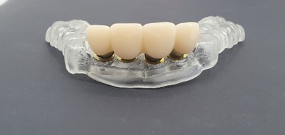 Simultaneous implantation with immediate loading in the aesthetic region of teeth 1.1, 1.2, 2.1, and 2.2 using a surgical template, by Dr. Khabibullo Negmatov (Art Dental Clinic, Russia)