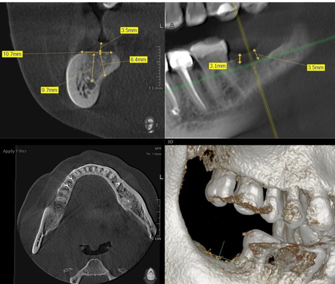 Short Single Implant in the Molar Region, by Dr. Sergey Popov and Dr. Marianna Vartanova (Russia)